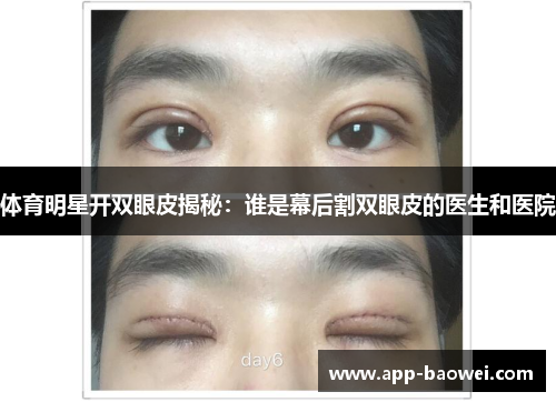 体育明星开双眼皮揭秘：谁是幕后割双眼皮的医生和医院